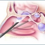 What Is Endoscopic Sinus Surgery