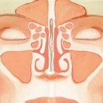 Balloon Dilation Sinus Surgery