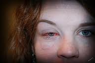 Viral vs. Bacterial Sinusitis
