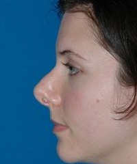 Primary Versus Revision Rhinoplasty