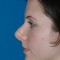 Primary Versus Revision Rhinoplasty