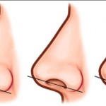Non Surgical Nose Job Risks