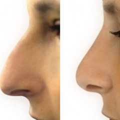 Cosmetic and Health Benefits of Rhinoplasty