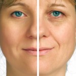 Rhinoplasty Combined with Laser Treatment for Facial Resurfacing