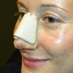 Rhinoplasty – Postoperative Advice and Instructions
