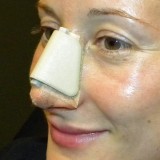 Rhinoplasty – Postoperative Advice and Instructions