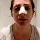 Nose Job – How to Speed Up Recovery?