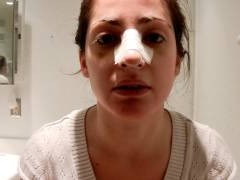 Nose Job – How to Speed Up Recovery?