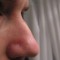 Male Rhinoplasty Helps You Achieve a More Masculine Look