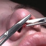 High Quality Surgery Video of Nose Job Rhinoplasty and Deviated Septum