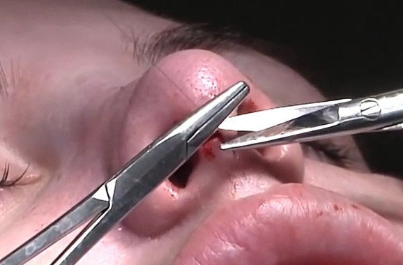 High Quality Surgery Video of Nose Job Rhinoplasty and Deviated Septum